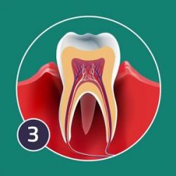 aggressive-periodontis-300x300