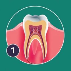 gingivitis-300x300