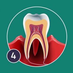 necrotising-periodontis-300x300